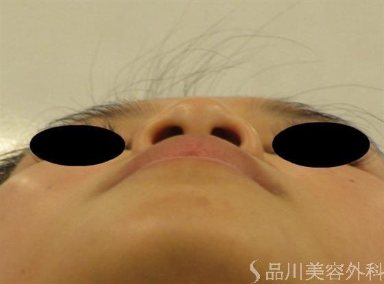 症例NO.48553のBEFORE写真