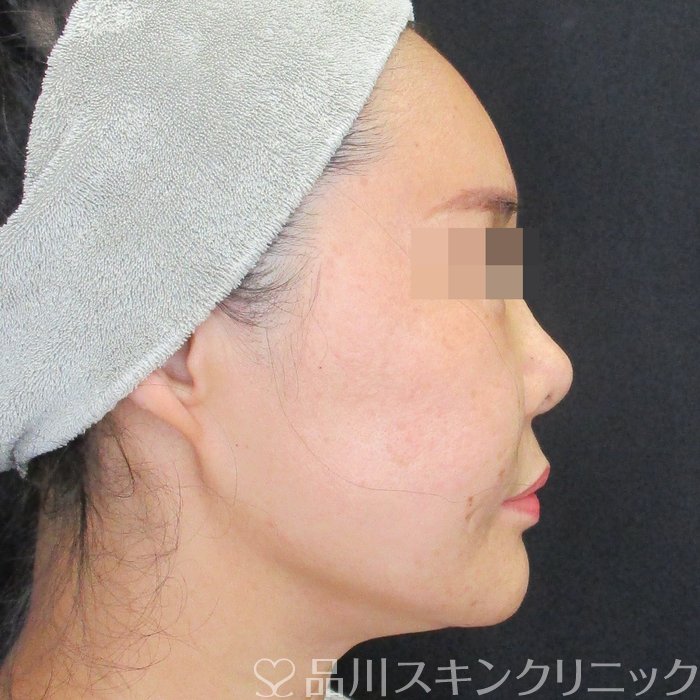 症例NO.74326のBEFORE写真