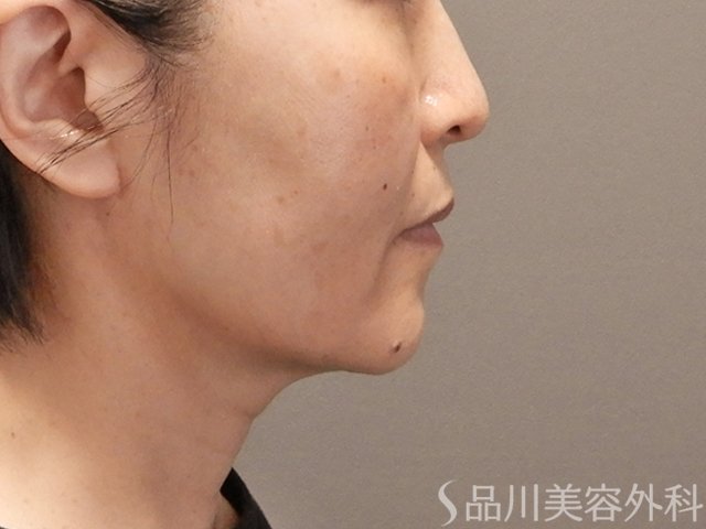 症例NO.75060のAFTER写真