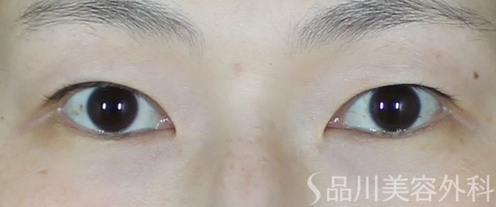 症例NO.70594のBEFORE写真