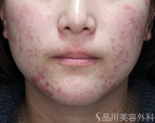 症例NO.73012のBEFORE写真