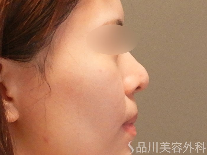 症例NO.67617のAFTER写真