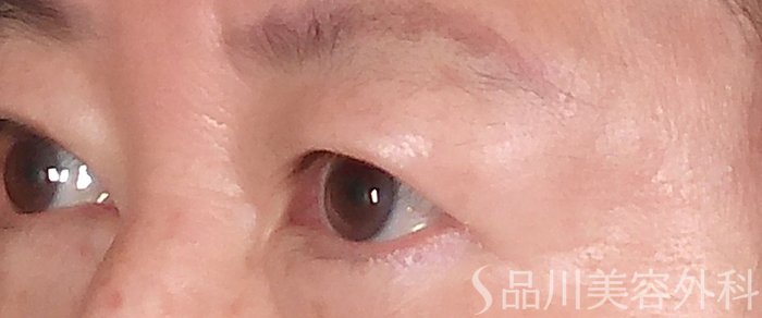 症例NO.70277のBEFORE写真