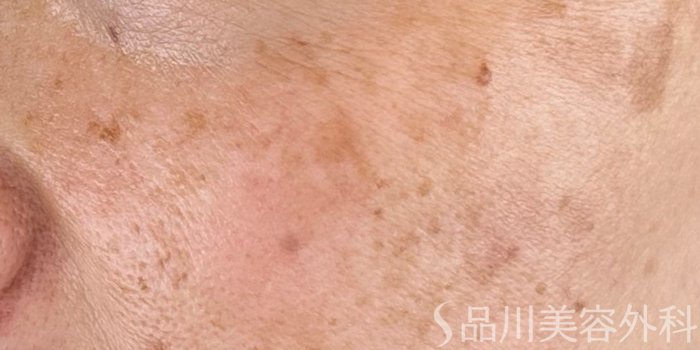症例NO.70663のAFTER写真