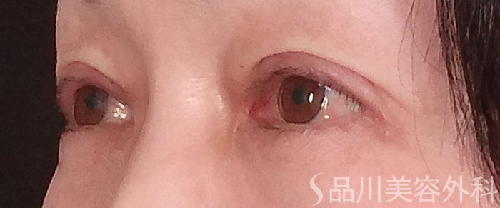 症例NO.69521のAFTER写真