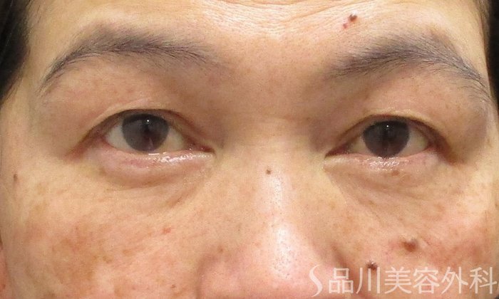 症例NO.70563のAFTER写真