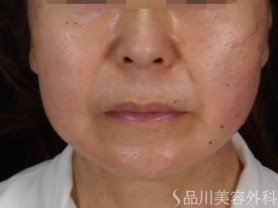 症例NO.71909のAFTER写真