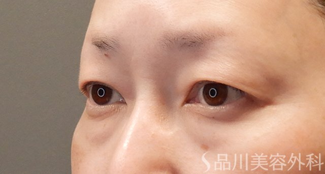症例NO.74956のBEFORE写真