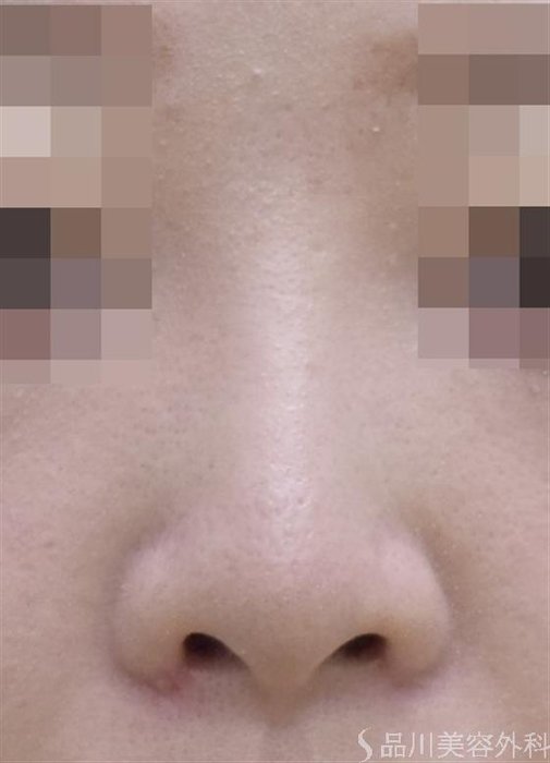 症例NO.48541のAFTER写真