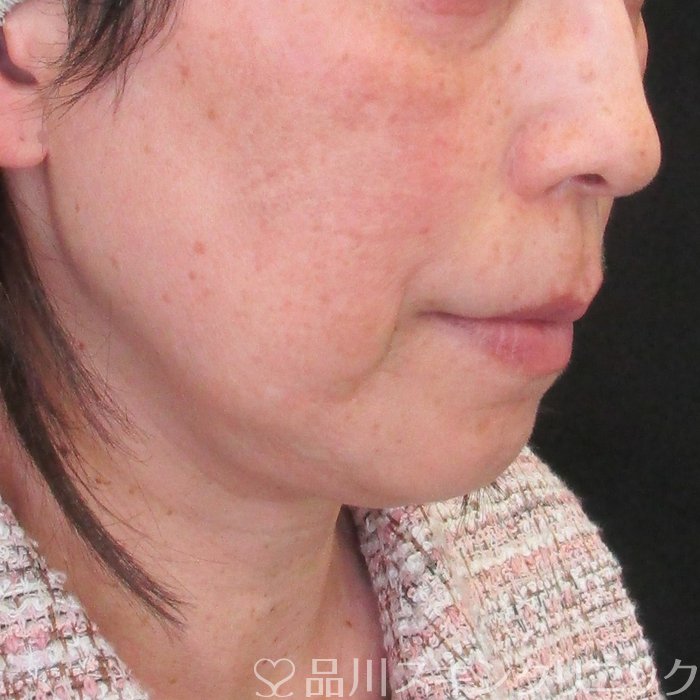 症例NO.73349のBEFORE写真