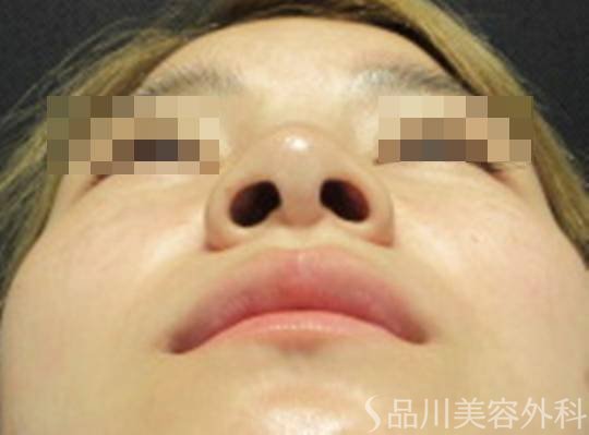 症例NO.74088のBEFORE写真