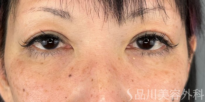 症例NO.70779のAFTER写真