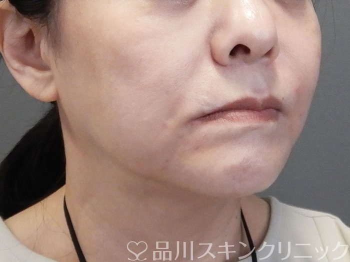症例NO.75179のAFTER写真