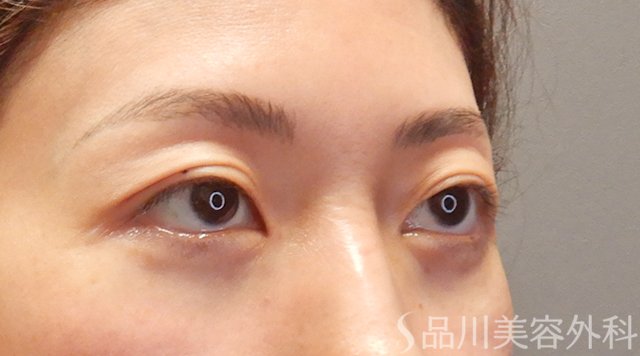 症例NO.73999のAFTER写真