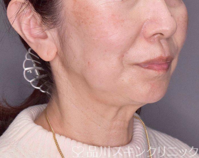 症例NO.70197のBEFORE写真