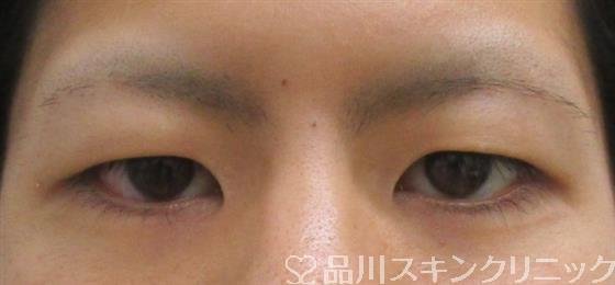 症例NO.42339のBEFORE写真