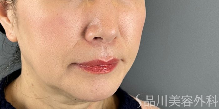 症例NO.70684のBEFORE写真