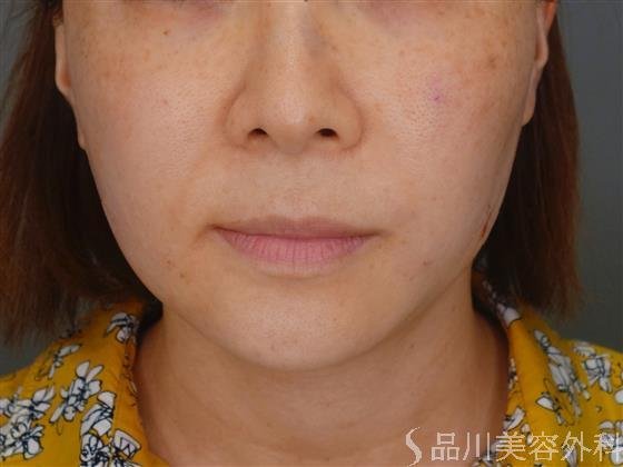症例NO.51282のAFTER写真