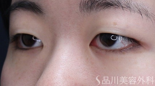 症例NO.69676のBEFORE写真