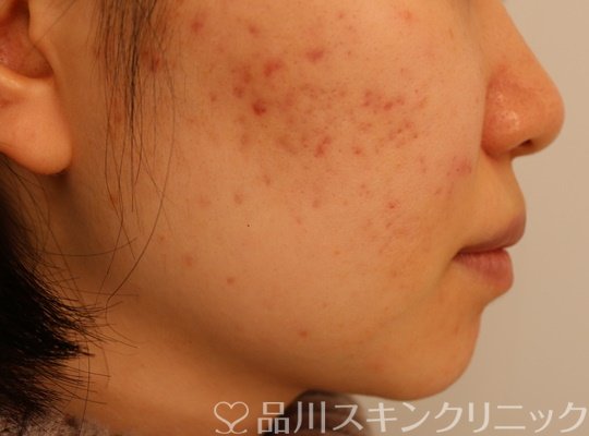 症例NO.72292のBEFORE写真