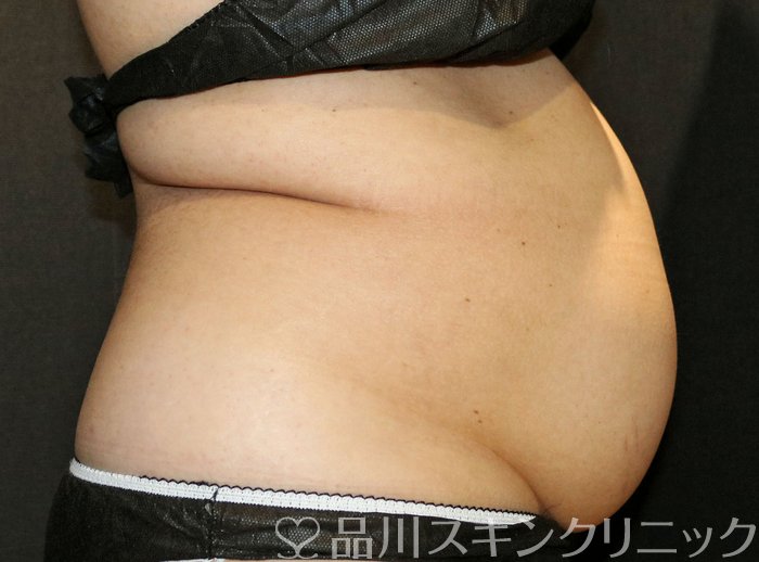 症例NO.72348のBEFORE写真