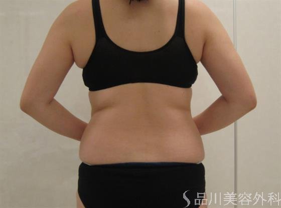 症例NO.50430のBEFORE写真