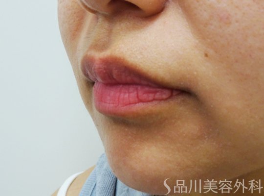 症例NO.72326のBEFORE写真