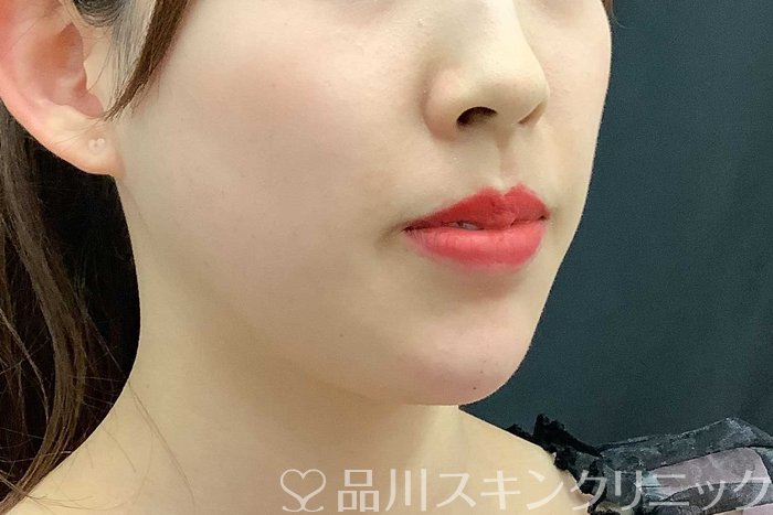 症例NO.69705のAFTER写真