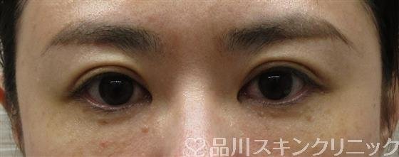 症例NO.61371のAFTER写真