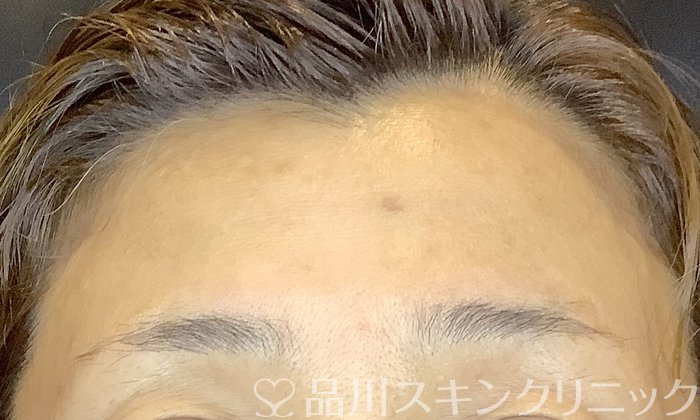 症例NO.65609のAFTER写真