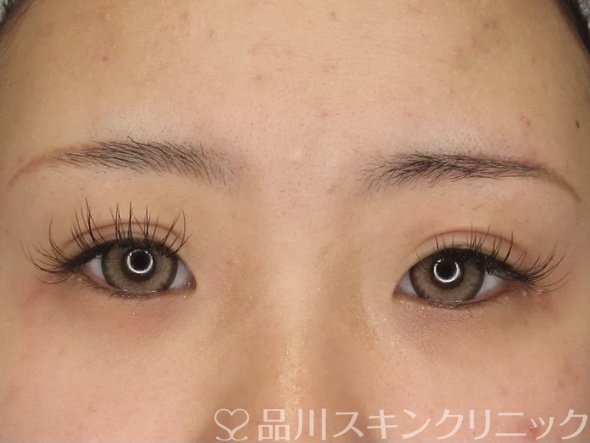 症例NO.69332のAFTER写真