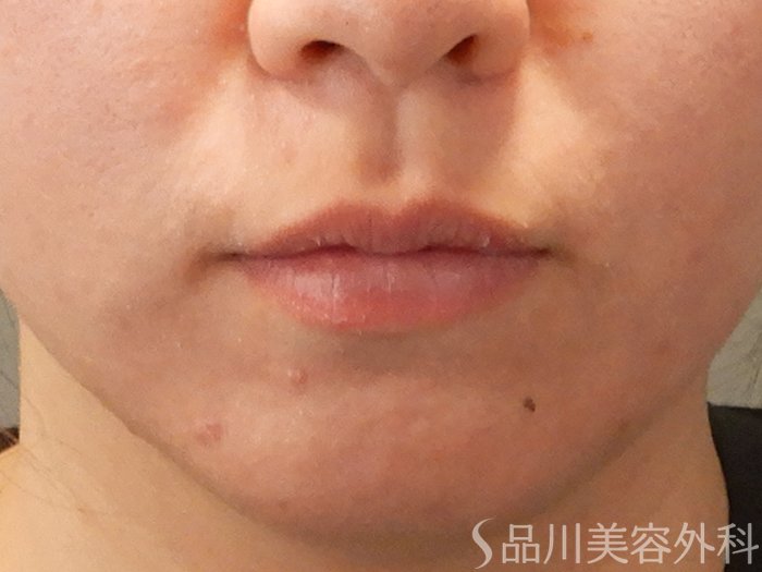 症例NO.70127のBEFORE写真