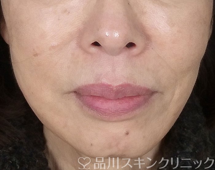 症例NO.69664のAFTER写真