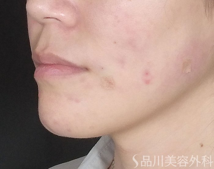 症例NO.69712のAFTER写真