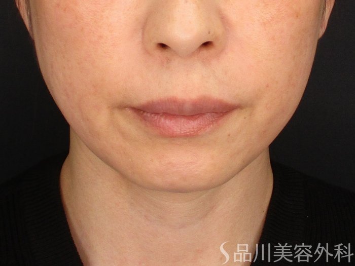 症例NO.73723のAFTER写真
