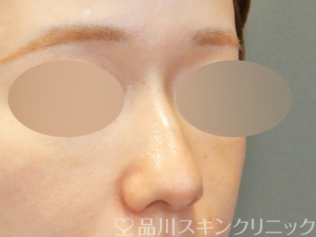 症例NO.67901のBEFORE写真