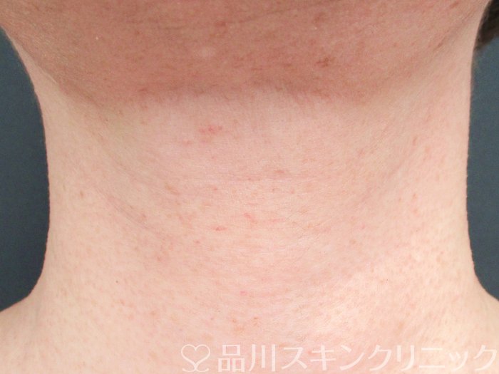 症例NO.74584のBEFORE写真