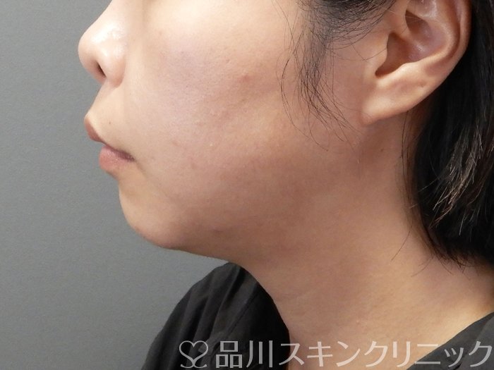 症例NO.72381のBEFORE写真