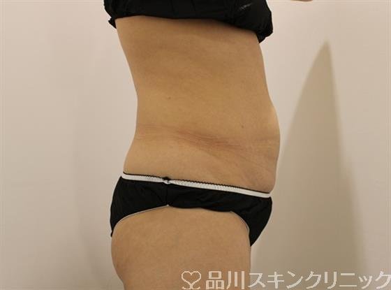 症例NO.44478のAFTER写真