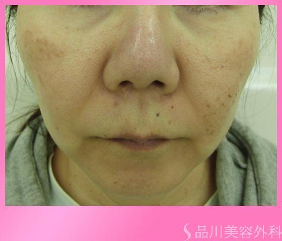 症例NO.2531のBEFORE写真