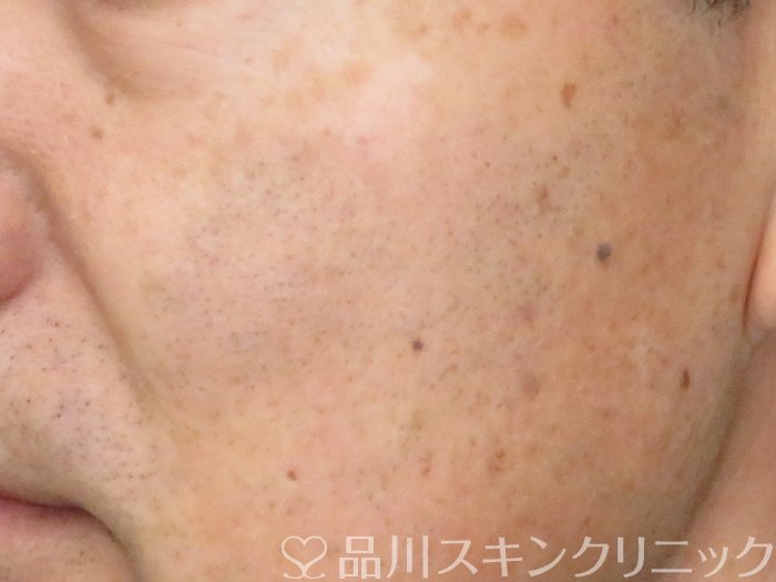 症例NO.69619のAFTER写真