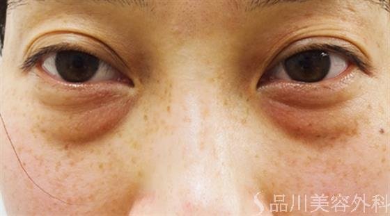 症例NO.31951のBEFORE写真