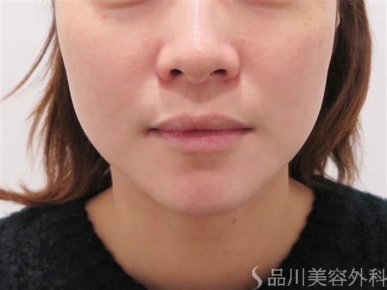 症例NO.45678のBEFORE写真
