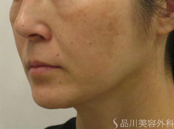 症例NO.47892のBEFORE写真