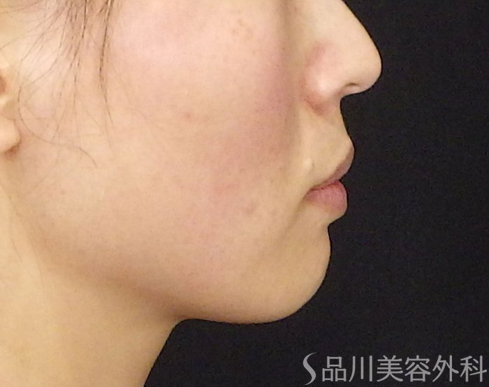 症例NO.71106のBEFORE写真