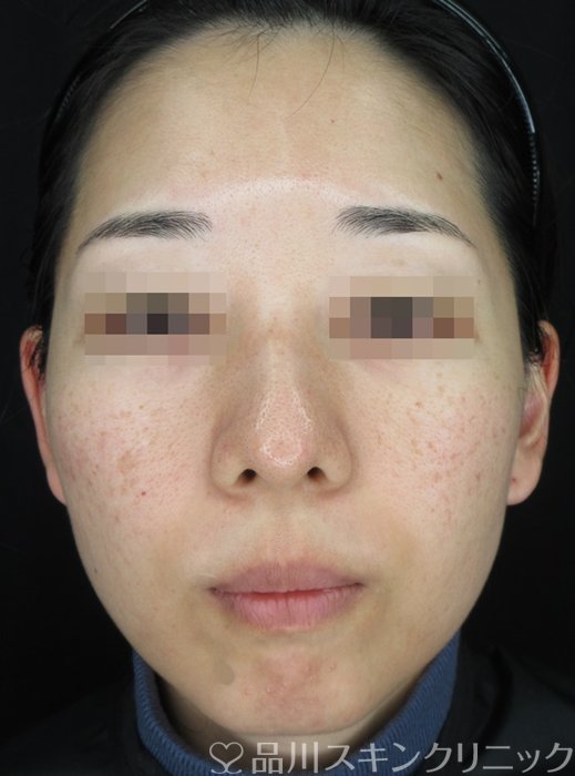 症例NO.71008のBEFORE写真