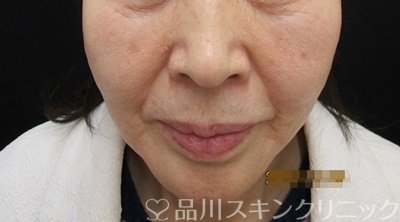 症例NO.65036のBEFORE写真