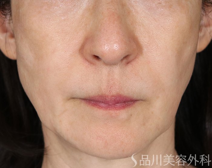 症例NO.71328のBEFORE写真