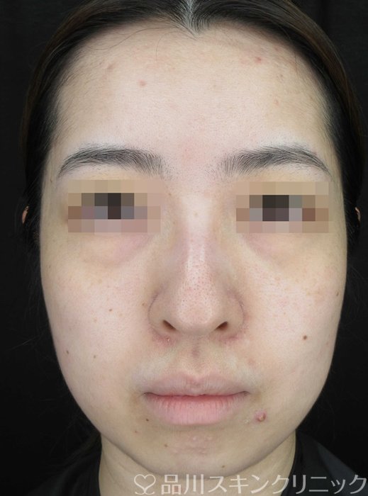 症例NO.67871のBEFORE写真