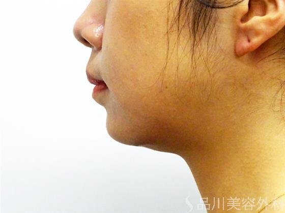 症例NO.52662のBEFORE写真